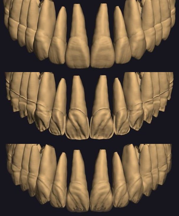 Exocad cutback view — TrueDentalLibrary framework ceramic space