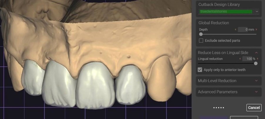 Selecting a cutback strategy in Exocad library panel