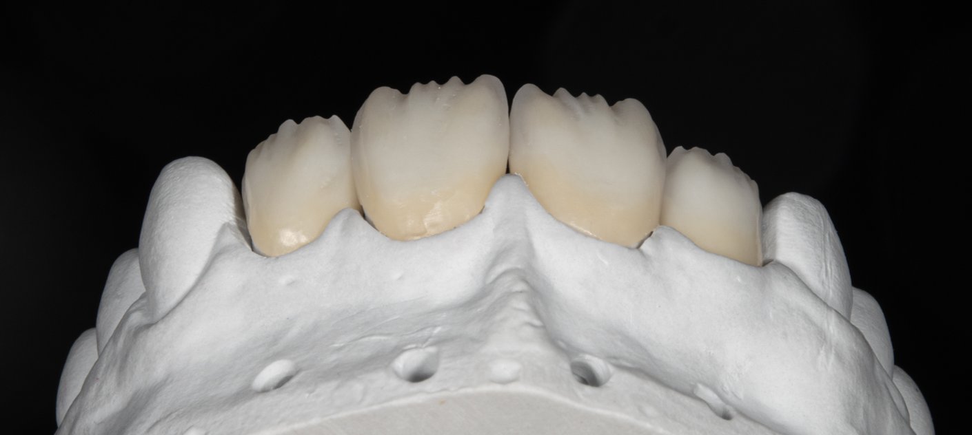 Applying the cutback library in Exocad — automated framework reduction