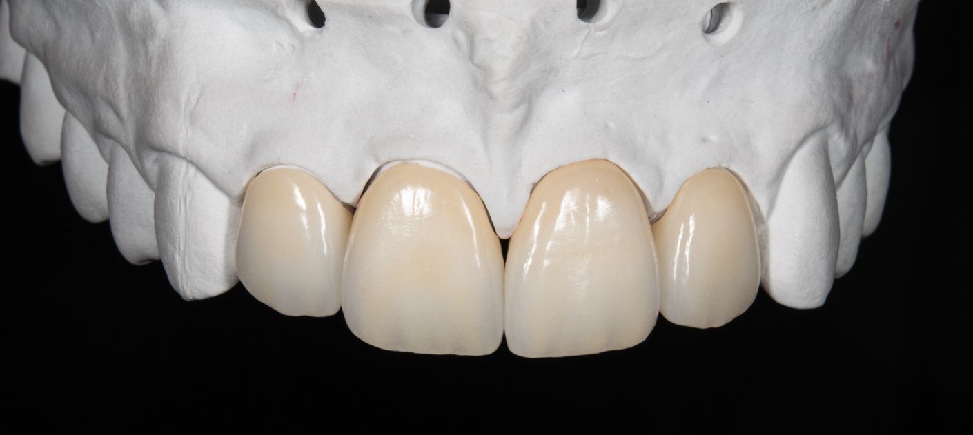 Milled framework with ceramic layering — final esthetic result