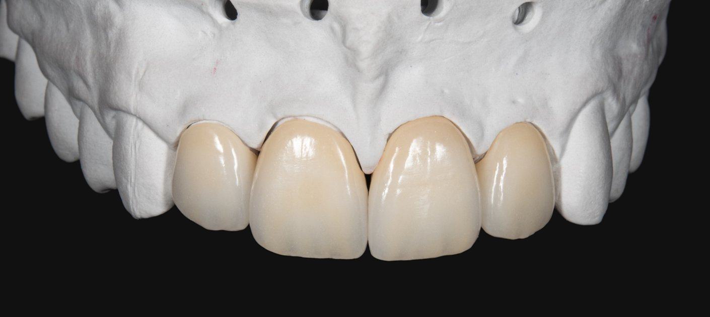 Finished layered ceramic restorations on the model